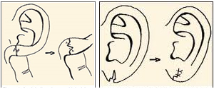 Surgery-split-or-torn-earlobes-Tunisia
